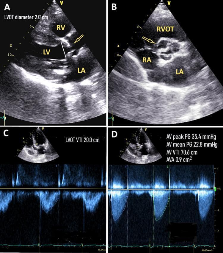 Transthoracic echocardiogram (TTE) panel demonstrating the diagnostic assessment of aortic stenosis. Panel A shows a parasternal long-axis view with a thickened, calcified aortic valve and restricted leaflet opening (arrow); the Left Ventricle Outflow Tract (LVOT) diameter is measured. Panel B provides a parasternal short-axis view (basin view) confirming valvular calcification and reduced orifice area. Panel C displays pulsed-wave Doppler at the apical five-chamber view measuring the LVOT Velocity Time Integral (VTI) at 20.0 cm. Panel D utilizes continuous-wave Doppler across the aortic valve to calculate hemodynamic parameters, including a mean pressure gradient of 22.8 mmHg and a calculated Aortic Valve Area (AVA) of 0.9 cm². The combination of these findings—specifically a low mean gradient (<40 mmHg) despite a small valve area (<1.0 cm²)—is characteristic of low-gradient severe aortic stenosis. Key anatomical landmarks labeled include the Left Ventricle (LV), Right Ventricle (RV), Left Atrium (LA), and Right Atrium (RA).