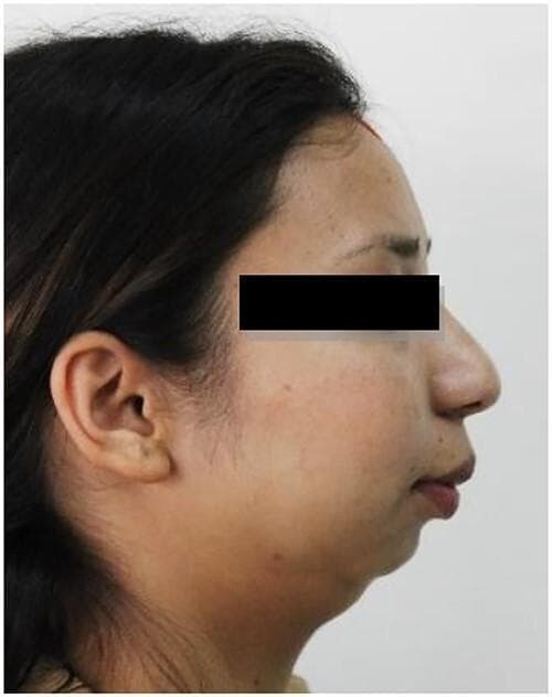 This clinical photograph shows a right lateral profile view of a patient's face, illustrating a classic 'bird face deformity' associated with mandibular hypoplasia. The primary diagnostic feature is a significantly receding chin (micrognathia) and a retrognathic mandible, where the lower jaw is set far back relative to the maxilla and upper face. This skeletal deficiency results in a relative prominence of the nose and a convex facial profile. The submental-neck angle is obtuse due to the lack of anterior mandibular projection, and the lips appear forward-positioned in relation to the retruded chin. The image serves as a clinical example of the aesthetic and structural impact of severe mandibular underdevelopment, often seen in cases of temporomandibular joint (TMJ) ankylosis or congenital conditions affecting craniofacial growth. The educational focus is on identifying skeletal dysmorphology and its impact on the cervicomental angle and facial symmetry.