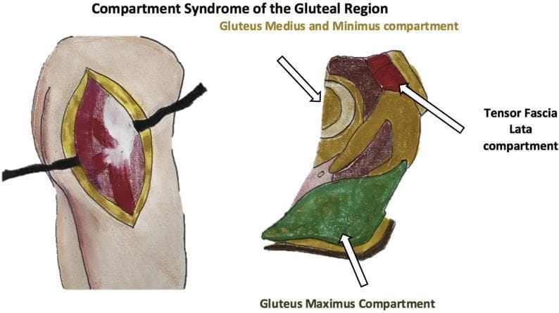 This composite medical illustration depicts the surgical and anatomical aspects of compartment syndrome in the gluteal region. The image is divided into two primary sections: a surgical clinical illustration and an anatomical diagram. On the left, a surgical illustration shows a decompressive fasciotomy of the right buttock with the patient in a lateral decubitus position. A large, linear incision through the skin and fascia exposes bulging muscle tissue, which appears edematous and reddish with focal pale areas, suggesting pressure-induced ischemia or muscle fiber disruption. On the right, a color-coded anatomical diagram identifies the three non-distensible fascial compartments of the gluteal region: the tensor fascia lata compartment (positioned anteriorly in red), the gluteus medius and minimus compartment (located centrally with a layered appearance), and the gluteus maximus compartment (positioned posteriorly in green). White arrows indicate the specific spatial boundaries and contents of each compartment. This visual serves as an educational tool for orthopedic surgery and emergency medicine, demonstrating the surgical management (fasciotomy) and the underlying regional anatomy relevant to diagnosing and treating acute gluteal compartment syndrome.