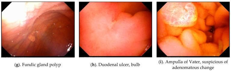 This composite clinical diagnostic image features three endoscopic frames (g, h, i) obtained via Magnetically Controlled Capsule Endoscopy (MACE), demonstrating various upper gastrointestinal organic lesions. Image (g) depicts a fundic gland polyp within the stomach, appearing as a small, smooth, rounded sessile protrusion from the reddish-brown mucosal wall. Image (h) shows the duodenal bulb containing a duodenal ulcer, characterized by a localized area of mucosal depression and pale fibrinoid coating amidst surrounding erythematous tissue. Image (i) focuses on the Ampulla of Vater showing suspicious adenomatous changes, visualized as a complex, multi-lobulated, and nodular structure with variegated yellow-red coloration and irregular surface texture compared to the surrounding duodenal mucosa. These images serve as educational examples of common and significant gastric and duodenal findings in geriatric patients, emphasizing the utility of capsule endoscopy in identifying benign polyps, peptic ulcer disease, and potentially premalignant anatomical changes in the periampullary region.