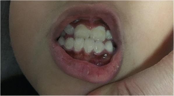This clinical photograph shows an intraoral view of a pediatric patient exhibiting Burton’s line, a characteristic sign of chronic lead poisoning (plumbism). The image reveals a distinct, dark bluish-grey linear band of pigmentation along the gingival margins where the gums meet the teeth. This hyperpigmented line is visible on both the maxillary and mandibular gingiva. The dental examination shows yellowish-white primary or mixed dentition with evidence of mild crowding and plaque accumulation. The clinical significance of this finding lies in its association with lead exposure, where lead reacts with sulfur-producing bacteria in the oral cavity to form lead sulfide precipitates within the gingival tissue. This sign is typically more prominent in patients with poor oral hygiene. The photograph serves as a diagnostic visual for toxicology and pediatric dental education, illustrating the systemic manifestations of heavy metal toxicity in the oral cavity.