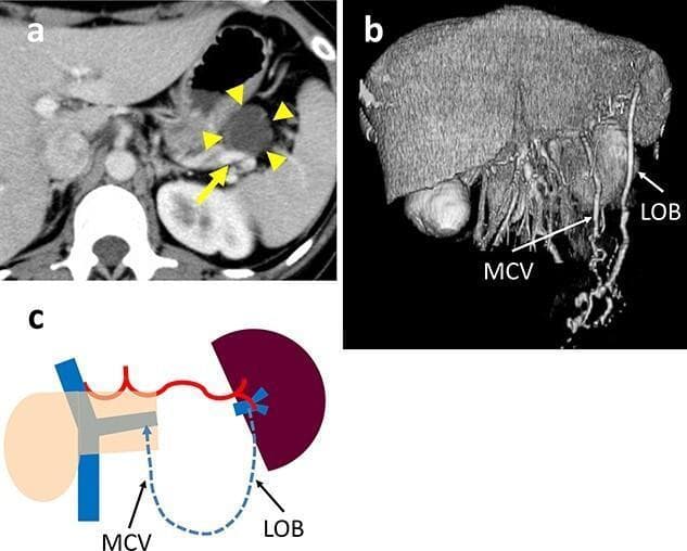 This composite educational figure illustrates the clinical imaging and venous anatomy associated with a pancreatic tail tumor. (a) Axial contrast-enhanced CT scan demonstrates a well-circumscribed, 35-mm hypodense cystic mass (yellow arrowheads) in the pancreatic tail. The lesion shows direct contact with the splenic vein (SpV, yellow arrow), which is a critical consideration for spleen-preserving distal pancreatectomy. (b) 3D vascular reconstruction highlights postoperative or compensatory collateral circulation, identifying a prominent arcade formed by a dilated left omental branch (LOB) and the middle colic vein (MCV). These vessels represent alternative venous drainage pathways from the spleen. (c) Pathophysiology diagram (schema) summarizes the venous return logic, showing blood flow (dashed blue line) from the spleen via the LOB and MCV into the portal system, bypassing the original splenic vein route. The content is designed for advanced surgical and radiological education, focusing on oncological staging and the preservation of splenic perfusion in pancreatic surgery.