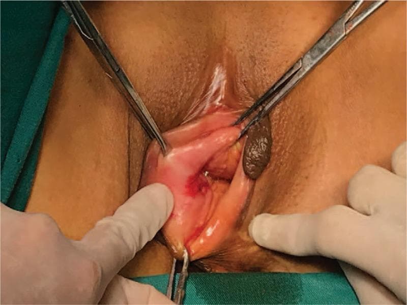 This clinical photograph displays a surgical examination of the vulva, identifying two distinct adjacent lesions classified as a collision tumor. The first lesion is located on the posterior aspect of the right labium majora, characterized by a 2.0 cm x 1.5 cm ulcerated area with significant anabrosis (surface erosion) and focal erythema, representing a poorly differentiated squamous cell carcinoma. Immediately adjacent is a second, larger mass associated with the Bartholin gland, appearing as a 3.0 cm x 2.0 cm well-circumscribed, solid, dark brown to black nodule with a smooth, expansile margin. This second component was histopathologically confirmed as an adenosquamous carcinoma. Surgical forceps and gloved hands are shown retracting the labial tissue to expose the lesions during the preoperative or intraoperative assessment. The visual highlights the morphological differences between primary vulvar squamous cell carcinoma (ulcerative) and Bartholin gland malignancies (solid, circumscribed mass), illustrating a rare clinical presentation associated with long-term high-risk HPV-16 and HPV-59 infection.
