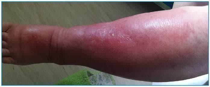 This clinical photograph displays a lateral view of a left lower limb manifesting classic inflammatory signs indicative of cellulitis or severe soft tissue infection. The image captures the leg from the dorsum of the foot to the upper calf/knee area. Key visual features include diffuse, poorly circumscribed erythema that is most intense along the anterior surface of the leg. Marked non-pitting edema (noted clinically as Godet grade III/IV) is evident, resulting in a swollen, tubular appearance of the limb that obscures normal anatomical bony landmarks of the ankle and shin. The skin surface appears tense, taut, and shiny, reflecting significant underlying tissue swelling. No obvious bullae, necrosis, or abscesses are visible in this view, though the dorsum of the foot exhibits exuberant swelling. This material serves as an educational example of acute bacterial skin and soft tissue infection (SSTTIs), demonstrating the cardinal signs of inflammation: rubor (redness) and tumor (swelling), relevant for dermatology and infectious disease specialties.