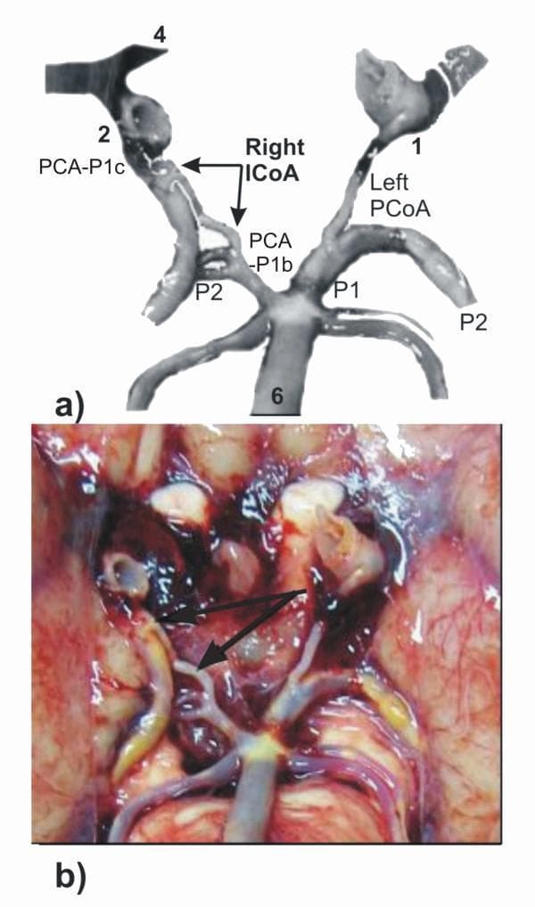 This medical figure consists of an anatomical diagram (a) and a matching intraoperative/cadaveric photograph (b) illustrating an anatomical variant in the posterior Circle of Willis. The visual focus is the 'intermediate communicating artery' (ICoA) on the right side. In the diagram, the right posterior cerebral artery (PCA) is shown with dual pre-communicating origins: a carotid origin segment (PCA-P1c) and a basilar origin segment (PCA-P1b), linked by the right ICoA (indicated by arrows). The left side shows a conventional posterior communicating artery (PCoA) connecting the internal carotid artery (1) to the PCA. Other labeled structures include the basilar artery (6), internal carotid arteries (1, 2), and the post-communicating PCA segments (P2). The clinical photograph (b) provides a real-world correlate of this vascular configuration on the basal surface of the brain, highlighting the small caliber and anatomical path of the accessory ICoA. This material is designed for advanced neuroanatomical education, demonstrating rare vascular complexities and variations in cerebral blood supply.