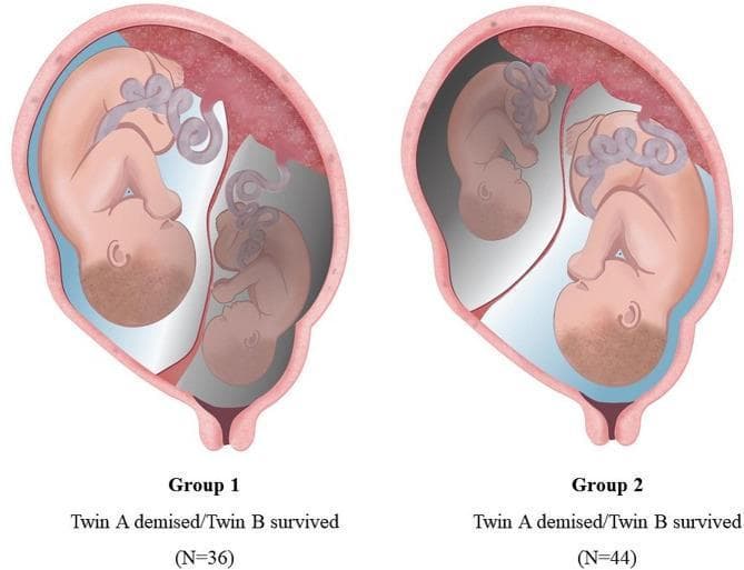 A medical anatomical diagram illustrating two clinical classifications of twin pregnancies complicated by single fetal demise (SFD). Both illustrations depict a monochorionic diamniotic (MCDA) twin pregnancy within a uterus, showing a shared fundal placenta and individual umbilical cords. In 'Group 1 (n=36)', the presenting twin (Twin A, located closest to the cervix) is the demised fetus, visualized as smaller and in a gray tone, while the non-presenting twin (Twin B) is larger and healthy. In 'Group 2 (n=44)', the non-presenting twin (Twin A, located at the fundus) is the demised fetus, while the presenting twin (Twin B) appears healthy. This comparison focuses on the impact of the demised twin's position relative to the birth canal on obstetric outcomes, such as preterm birth and gestational age at delivery. The diagram uses color coding and spatial positioning to differentiate between presenting and non-presenting status in the context of intrauterine fetal death.