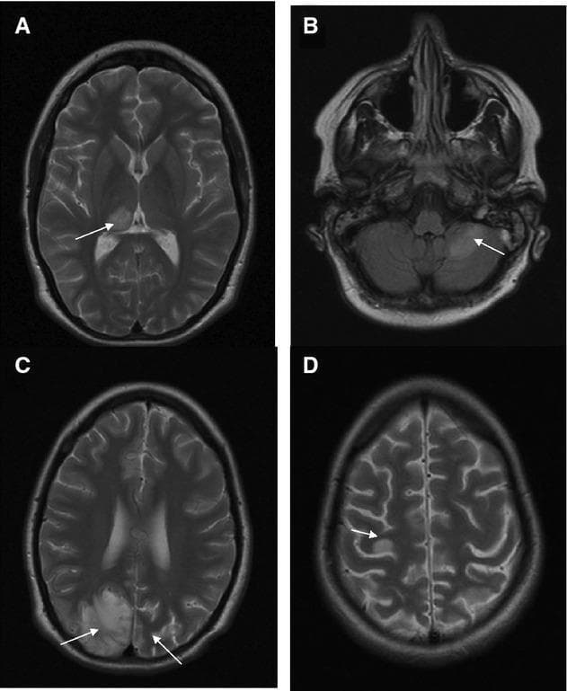 This diagnostic image set consists of four axial brain MRI scans (A, B, C, D) demonstrating the progression of neuropathology associated with POLG mutations and Alpers-Huttenlocher syndrome. Panel A (axial T2-weighted) shows a circumscribed hyperintense lesion in the right posterior thalamus. Panel B (axial FLAIR) reveals high signal intensity lesions in the left cerebellar hemisphere. Panel C (axial T2-weighted), taken two months later, illustrates bilateral, asymmetric parieto-occipital lesions involving both the cortical ribbon and subcortical white matter, with more extensive involvement on the right. Panel D (axial T2-weighted), from a follow-up three months later, shows new hyperintense focal lesions in the cortex (indicated by an arrow). The sequence demonstrates the characteristic migratory and fluctuating nature of brain lesions in POLG-related mitochondrial disease, often presenting as stroke-like episodes or focal status epilepticus. This visual record is significant for illustrating the evolution of metabolic-induced encephalopathy and cortical-subcortical signal changes over a five-month clinical course.