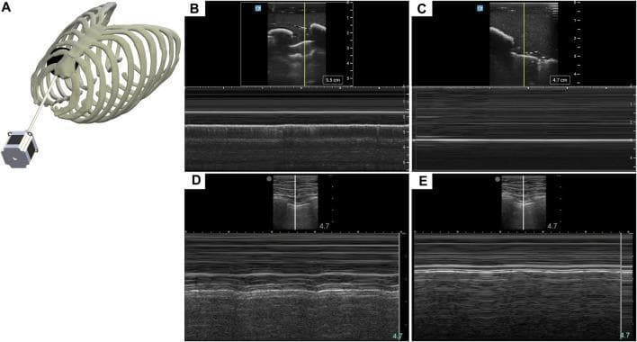 This composite image illustrates the use of M-mode ultrasonography for the diagnosis of pneumothorax (PTX) using both a tissue phantom and human simulator scans. (A) Anatomical diagram showing a rib cage phantom with an integrated actuator mechanism used to simulate lung respiration. (B) M-mode ultrasound image of the phantom showing the 'seashore' sign, characterized by a granular, textured appearance deep to the pleural line, indicating normal lung sliding. (C) M-mode image of the phantom showing the 'barcode' or 'stratosphere' sign, where parallel horizontal lines replace the granular texture, signifying the absence of lung sliding indicative of a pneumothorax. (D) Human eFAST simulator baseline scan demonstrating normal respiratory motion in M-mode with undulating lines and heterogeneous texture. (E) Human eFAST simulator scan showing PTX injury with rigid, striated echogenic lines and a uniform linear pattern. These visual signatures are critical landmarks in the eFAST (Extended Focused Assessment with Sonography for Trauma) protocol for identifying air in the pleural cavity.