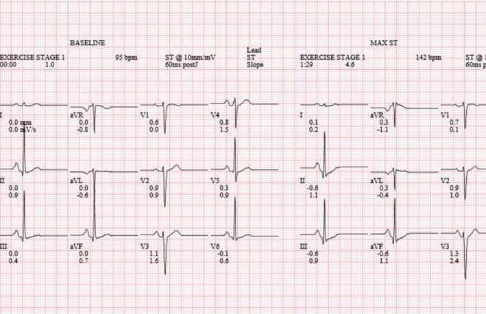 This diagnostic image is a 12-lead electrocardiogram (EKG) comparison chart from a stress echocardiogram procedure. The visual layout presents a side-by-side comparison of cardiac electrical activity at two distinct phases: 'Baseline' (left) recorded at 95 bpm, and 'Max ST' during Exercise Stage 1 (right) recorded at 142 bpm. The EKG focuses on precordial leads (V1-V6) and limb leads (I, II, III, aVR, aVL, aVF). Key visual findings at baseline include a blunted R-wave progression from V1 to V3, characterized by small R-wave amplitudes followed by deeper S-waves. Under exercise stress (MAX ST), the image demonstrates morphology changes in the ST segments and T-waves, specifically upright T-waves and shifts in the ST-segment slope measured at 60ms post-J point. The chart includes quantitative annotations for ST-segment deviation (mm) and slope (mV/s) beneath each lead label. This visual serves as an educational tool for assessing exercise-induced ischemic changes, evaluating R-wave progression, and monitoring heart rate response during cardiac stress testing.