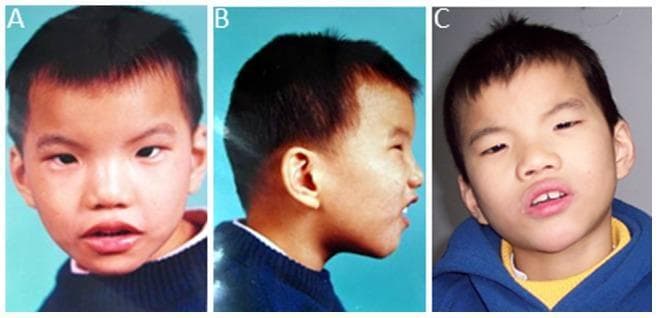 Clinical photographs of a male pediatric patient with 5p deletion syndrome (Cri-du-chat syndrome) at age 4.5 years (panels A and B) and 11.75 years (panel C). The frontal views (A, C) demonstrate characteristic dysmorphic features including a round facial profile, microcephaly, and pronounced hypertelorism (widely spaced eyes). Notable ocular findings include an upslanting palpebral fissure (external canthus upslope) and esotropia. Midface features include a broad, large nasal bridge and a short philtrum. The profile view (B) highlights micrognathia (a small, receding jaw), midfacial hypoplasia, and low-set ears. Additionally, the images show evidence of plagiocephaly (asymmetric skull distortion). These visual findings are consistent with the phenotypic manifestations of interstitial deletion of chromosome 5p13.3p15.3, used here for medical education on genetic dysmorphology and developmental delay syndromes.