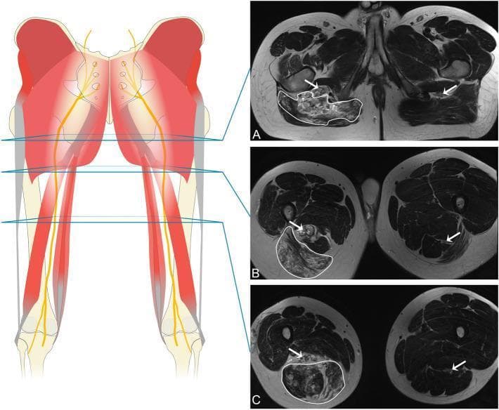 This composite educational graphic features an anatomical diagram and three axial MRI images (T2-weighted) demonstrating a widespread venous malformation (VM) of the right thigh. The anatomical diagram on the left illustrates the posterior lower limb musculature and the course of the sciatic nerve, with blue lines indicating the axial cross-section levels for the MRIs. The MRI sequence (A-C) provides a comparative view of the affected right limb versus the healthy left limb. White outlines in the right thigh highlight extensive intramuscular infiltration of the VM. Image A (proximal) shows infiltration of the gluteal muscles. Image B (mid-thigh) shows involvement of the distal gluteus maximus and proximal hamstrings. Image C (distal) demonstrates infiltration of the semimembranosus, semitendinosus, and biceps femoris. White arrows identify the sciatic nerve bilaterally; on the right side, the nerve shows altered signal intensity and morphological distortion due to extraneural and subepineurial infiltration. This material is designed for teaching radiological identification of vascular anomalies and their secondary effects on peripheral nerves and skeletal muscle.