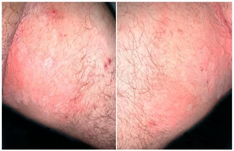 Clinical photograph of the upper inner thighs showing a pruritic erythemato-squamous dermatosis. The image displays thin, erythematous plaques characterized by a distinct arciform and annular morphology. The plaques feature prominent squamous (scaly) borders that appear slightly raised and peripheral, typical of a dermatophyte infection. Subtle secondary cutaneous findings include small, scattered punctate red lesions within the plaques, suggestive of excoriations from scratching. The distribution is bilateral and localized to the inguinal and femoral regions. These visual findings are clinically consistent with tinea cruris, a superficial fungal infection. Educational focus includes recognizing the characteristic annular 'ringworm' pattern, the squamous nature of the active border, and differentiating chronic inflammatory plaques from other common groin dermatoses.