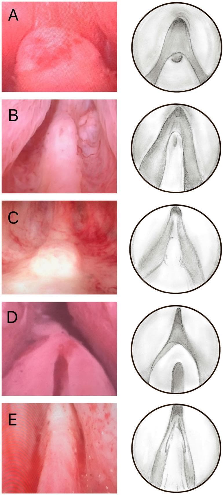 A medical comparison chart illustrating five morphological types of the verumontanum (seminal colliculus) as seen during cystoscopy. The image is organized into two columns: the left shows actual endoscopic clinical photographs, and the right presents corresponding illustrative diagrams highlighting structural anatomy. The five classified types are: (A) Volcano: a short, rounded structure with a superiorly located utricle; (B) Lighthouse: an elongated, more prominent colliculus with an anterior utricle; (C) Whale Tail: a flattened, broad organ with a prominent, split-appearing urethral crest; (D) Castle Door: a wide, short structure featuring a significantly enlarged prostatic utricle; (E) Hood: a tapered, elongated form that is continuous with the urethral crest. This visual classification is used in urology to standardize anatomical variations of the prostatic urethra, specifically for surgical planning in procedures like transurethral resection of the prostate (TURP). The images highlight key landmarks including the prostatic utricle and the urethral crest.
