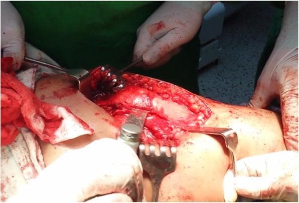 This clinical photograph captures an intraoperative view of a trochanteric osteotomy, a specialized orthopedic surgical procedure. The operative field is focused on the proximal femur and hip region, where deep surgical dissection has exposed the underlying musculoskeletal structures. Multiple surgical instruments are actively engaged in the field: several metallic retractors (including Hohmann and rake-type retractors) are strategically positioned to provide visualization by retracting the skin, subcutaneous fat, and muscle layers. An oscillating bone saw is visible in the center, applied to the cortical surface of the femur to perform the osteotomy. Visible anatomy includes the exposed femoral bone and surrounding vascularized muscle tissue. The clinical focus of this image is to demonstrate the surgical technique for trochanteric mobilization, often utilized in hip preservation surgery or complex arthroplasty to improve access to the hip joint while maintaining the continuity of the abductor mechanism. The procedure is relevant for orthopedic residents and surgeons studying hip reconstruction and surgical dislocation techniques.