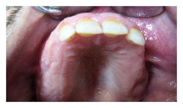 This intraoral clinical photograph provides a 1-year postoperative palatal view of the maxillary arch in a patient previously treated for Florid Cemento-Osseous Dysplasia (FCOD). The image shows the hard palate and the remaining anterior maxillary teeth. The palatal mucosa and gingiva appear healthy, pink, and well-keratinized, with no signs of active inflammation, ulceration, or infection. Notable findings include significant expansion and irregularity of the alveolar ridge, consistent with the underlying fibro-osseous disease process. The visible anterior teeth exhibit yellowish discoloration, incisal wear, and slight malalignment. The posterior areas of the arch appear partially edentulous following surgical recontouring and extractions to facilitate prosthetic rehabilitation. The clinical presentation highlights the stabilized state of the maxillary arch one year after surgical intervention for FCOD, emphasizing the healed soft tissue over the recontoured cortical bone.