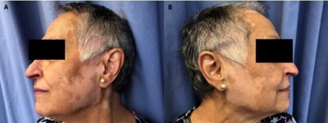 Clinical photograph of a patient's face and neck, shown in bilateral lateral profiles, illustrating features of drug-induced vitiligo. The image displays multiple sharply demarcated, achromic (depigmented) macules and patches. These lesions are distributed symmetrically across the cheeks, preauricular areas, ears, and lateral neck. A significant finding is leukotrichia, where the depigmentation extends to involve the hair follicles along the temporal hairline and sideburns, resulting in localized white hair. The surrounding skin appears normally pigmented, creating a high-contrast border characteristic of vitiligo. This visual demonstrates common cutaneous side effects associated with targeted cancer therapies like ribociclib and letrozole. The clinical presentation is essential for medical students and dermatologists to distinguish between primary vitiligo and drug-induced leukoderma in oncological patients.