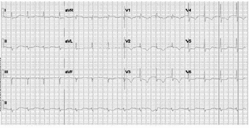 A 12-lead electrocardiogram (ECG) demonstrating a bifascicular block pattern. The tracing shows a sinus rhythm with several key conduction abnormalities. The limb leads reveal a marked left axis deviation (LAD), characterized by a predominantly positive QRS complex in lead I and a negative QRS complex in leads II and aVF, consistent with a left anterior fascicular block (LAFB). In the precordial leads (V1-V6), there is evidence of an incomplete right bundle branch block (IRBBB), indicated by an rSr' pattern in lead V1 and slurred S waves in the lateral leads (V5, V6). The PR interval is slightly prolonged, suggesting an associated first-degree atrioventricular (AV) block. This combination of LAFB and IRBBB constitutes a bifascicular block, which in the clinical context of aortic root abscess or infective endocarditis, may indicate progressive involvement of the cardiac conduction system.