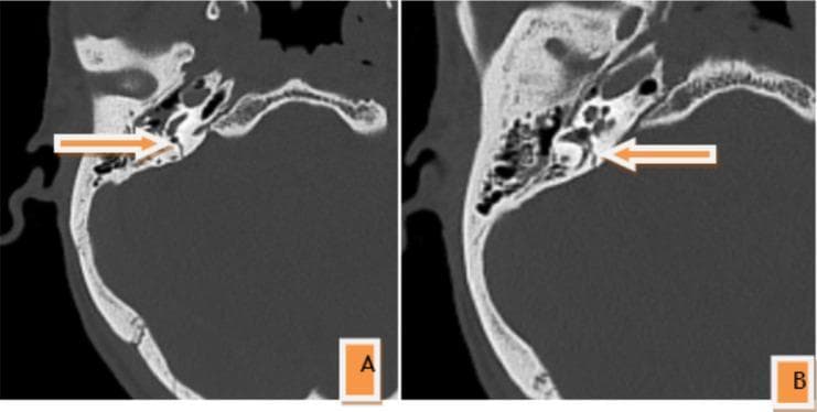 Two-panel axial non-contrast CT scan of the head in bone window settings demonstrating a right petrous temporal bone fracture. Panel A illustrates the fracture line traversing the petrous pyramid with involvement of the internal carotid artery (ICA) canal. Panel B shows the extension of the fracture into the jugular fossa walls. White arrows indicate the fracture site. The fracture is characterized as a transverse pattern, which is clinically significant due to its violation of the otic capsule, the dense bony housing of the inner ear. The images display disruption of the bony architecture surrounding the cochlea and vestibular system, posing a high risk for sensorineural hearing loss and facial nerve injury. The surrounding mastoid air cells appear largely aerated, and the squamous part of the temporal bone remains intact. This diagnostic image is representative of high-impact craniofacial trauma in adult patients.