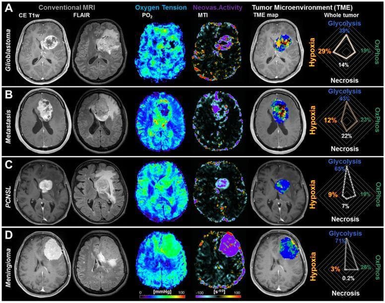 A multi-panel diagnostic imaging series demonstrating tumor microenvironment (TME) mapping across four brain tumor types: (A) Glioblastoma WHO grade 4, (B) Brain metastasis from breast cancer, (C) Primary central nervous system lymphoma (PCNSL), and (D) Meningioma. For each entity, axial MRI slices are presented across five modalities: Conventional CE T1w, FLAIR, tissue oxygen tension (PO2) maps, neovascularization activity (MTI) maps, and color-coded TME maps. Corresponding radar charts quantify metabolic compartments: Glycolysis (blue), Oxidative Phosphorylation (OxPhos, green), Necrosis (black), and Hypoxia (red/yellow). Glioblastoma (A) shows high heterogeneity with central necrosis and a significant hypoxic rim. The metastasis (B) shows a larger necrotic center compared to hypoxia. PCNSL (C) and Meningioma (D) exhibit metabolic dominance in aerobic glycolysis (65-71%) with higher oxygen tension and functional neovascularization, showing minimal necrosis. This visual data illustrates how advanced MRI mapping can differentiate tumor physiology based on metabolic signatures and vascular integrity.