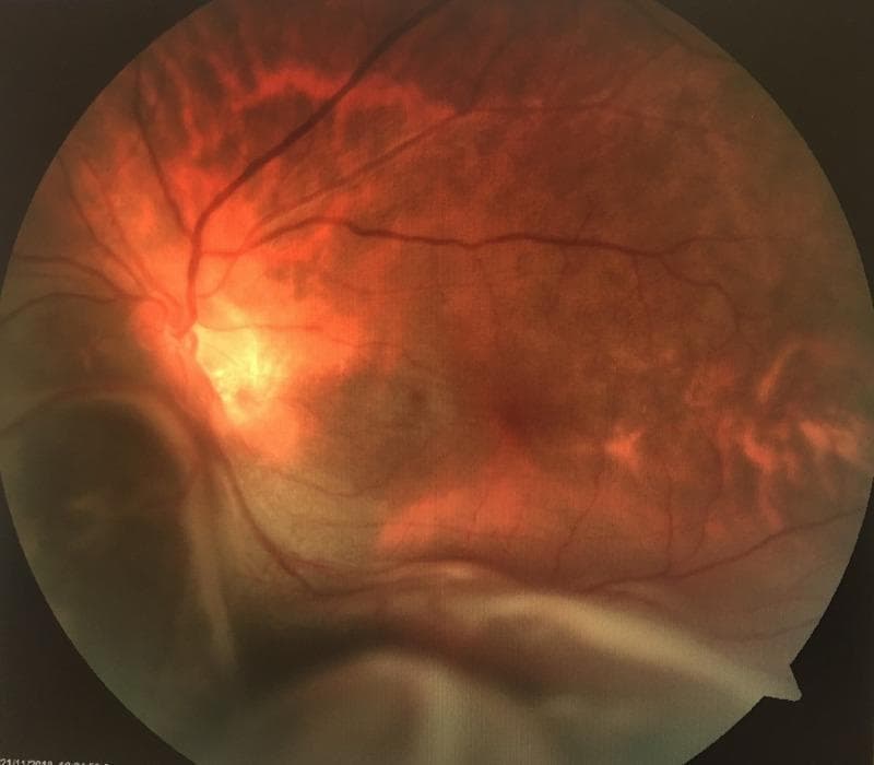This color fundus photograph of the left eye illustrates a prominent bullous exudative retinal detachment located in the inferonasal region. The detached retina appears as a large, smooth, elevated grayish-white convex surface that obscures the lower margins of the optic disc and the inferior retinal vasculature. Yellowish-white subretinal exudates are visible adjacent to the area of detachment, suggesting an inflammatory or neoplastic underlying etiology rather than a rhegmatogenous cause. The remaining visible retina shows a reddish-orange hue with attenuated vessels, and the optic disc appears tilted, consistent with high myopia. There are no obvious intraretinal hemorrhages. This image is a classic representation used in ophthalmology for teaching the clinical presentation of non-rhegmatogenous retinal detachment and the importance of identifying subretinal masses or exudation during a posterior segment examination.