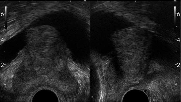 This diagnostic image consists of two grayscale prostate ultrasonography views (likely transverse and sagittal planes) demonstrating Benign Prostatic Hyperplasia (BPH) with significant mid-lobe hypertrophy. The prostate gland appears enlarged with a heterogeneous echotexture. A prominent, solid tissue mass originating from the median lobe is seen protruding superiorly into the anechoic (black) space of the bladder lumen. This intravesical prostatic protrusion (IPP) is a key clinical finding that correlates with bladder outlet obstruction. The image also displays standard sonographic depth markers on the lateral margins and a dark circular acoustic shadow at the bottom center, representing the position of the ultrasound probe. This material is used to teach medical students and urology residents the sonographic evaluation of lower urinary tract symptoms and the anatomical manifestations of prostatic enlargement.