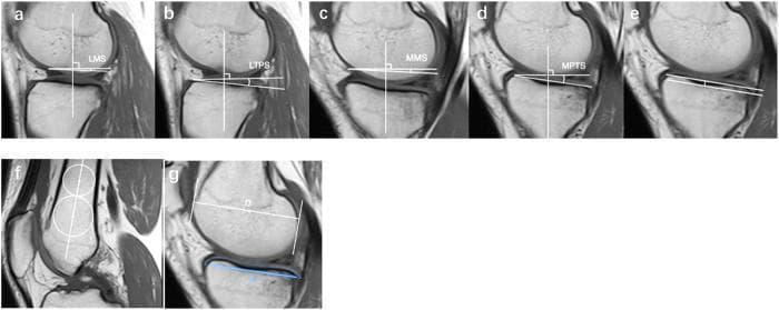 A series of seven sagittal MRI frames of a human knee joint (labeled a-g) demonstrating quantitative morphometric measurements used in orthopedic assessment, specifically for ACL and meniscus injury risk profiling. Panels a-d illustrate slope measurements relative to a vertical tibial reference line: (a) Lateral Meniscal Slope (LMS) and (c) Medial Meniscal Slope (MMS) measured along the superior meniscal borders; (b) Lateral Posterior Tibial Slope (LPTS) and (d) Medial Posterior Tibial Slope (MTPS) measured along the subchondral bone surface. Panel (e) depicts the measurement of medial posterior tibial depth. Panel (f) demonstrates the method for establishing the femoral longitudinal axis by connecting the midpoints of two circles tangent to the femoral shaft cortex. Panel (g) shows the measurement of the medial femoral condyle (MFC) diameter (D) using parallel lines tangent to the anterior-most and posterior-most aspects, and the medial tibial plateau (MTP) anterior-posterior length (L) based on the cartilaginous surface outline. These quantitative parameters are critical for evaluating anatomical predispositions to ramp lesions and ACL instability.