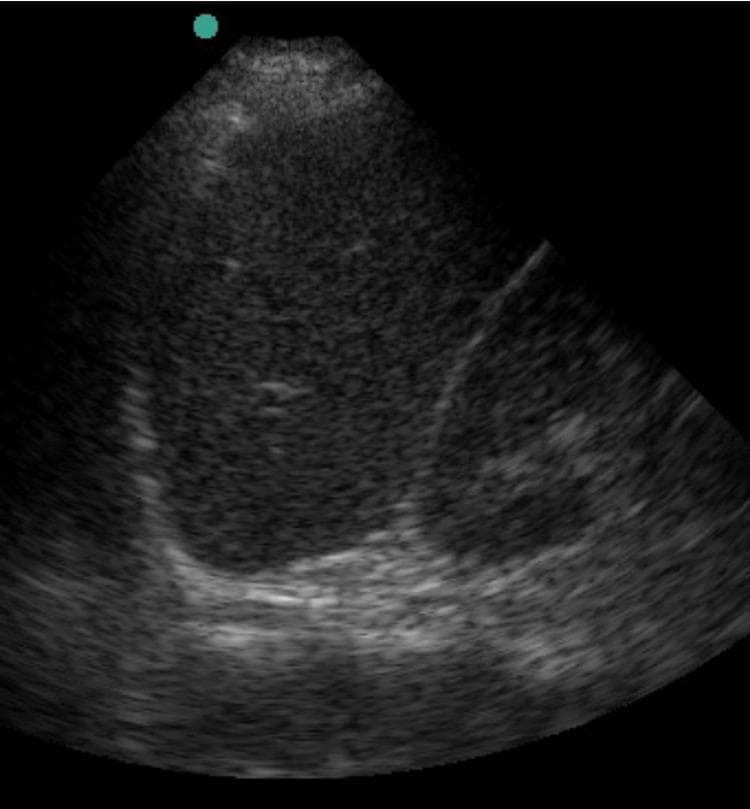 This grayscale diagnostic image is a B-mode ultrasound scan of the Left Upper Quadrant (LUQ), performed as part of a Focused Assessment with Sonography in Trauma (FAST) exam. The image displays a sector-shaped field of view focusing on the splenorenal interface. The primary organ visible is the spleen, which demonstrates a homogeneous, mid-level granular echotexture. Below the spleen, a hyperechoic (bright) linear interface is visible, representing the diaphragm and the superior pole of the left kidney (Koller's pouch). The clinical objective of this view in a trauma setting is to evaluate for the presence of anechoic (black) fluid, which would indicate hemoperitoneum or free intra-abdominal fluid in the potential space between the spleen and the kidney or in the subdiaphragmatic space. This specific scan does not show an obvious collection of free fluid, suggesting a negative LUQ FAST window at this cross-section. The image serves as a standard educational example of abdominal sonography for emergency medicine and surgical trauma protocols.