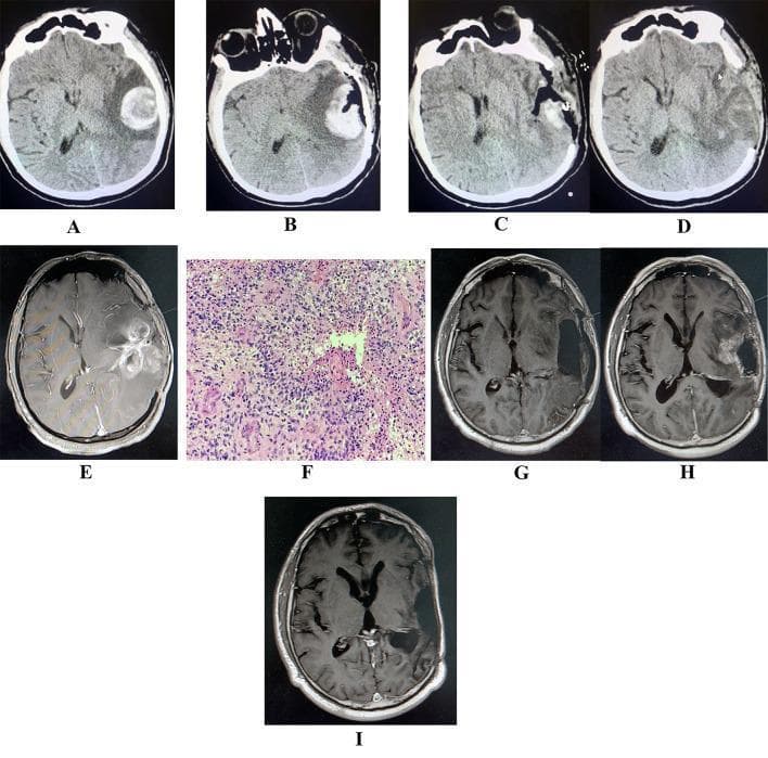 A longitudinal sequence of neuroradiological and histopathological images illustrating the progression and management of glioblastoma. (A) Initial non-contrast head CT shows an acute hyperdense left temporoparietal intraparenchymal hemorrhage with surrounding hypodense perihematomal edema. (B-D) Sequential CT scans following hematoma evacuation demonstrate post-surgical changes, including a decompressive craniectomy (bone flap removal) and persistent left-sided cerebral edema. (E) Axial T1-weighted contrast-enhanced MRI reveals a large, peripherally enhancing, ring-like space-occupying lesion with central necrosis in the same region, consistent with high-grade glioma. (F) H&E stained histopathology slide shows high-grade pleomorphic cells, hypercellularity, and microvascular proliferation, diagnostic of glioblastoma (WHO grade 4). (G) Post-resection MRI confirms gross total tumor removal. (H) Follow-up MRI at four months shows an enhancing mass in the surgical bed, indicating in-situ tumor recurrence. (I) Final MRI following targeted chemotherapeutic treatment with temozolomide and bevacizumab demonstrates a significant reduction in the recurrent tumor signal. This series highlights the clinical course of apoplectic glioma presentation, surgical intervention, and recurrence management.