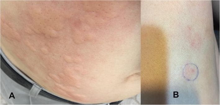 This composite clinical photograph illustrates two types of cutaneous allergic reactions to subcutaneous insulin administration in a patient with type 2 diabetes. Panel A shows a generalized urticarial reaction on the abdominal wall surrounding the umbilicus. Visually, this is characterized by multiple raised, pale-pink wheals of varying sizes and shapes, with some appearing confluent, surrounded by diffuse erythema (flares). The morphology is typical of a Type I hypersensitivity reaction. Panel B demonstrates a localized cutaneous reaction on the upper right thigh at an injection site. This milder presentation consists of localized erythema and slight edema; a specific point of interest is demarcated with a blue ink circle to highlight the injection site reaction. These images serve as educational visual aids for identifying common dermatological manifestations of insulin allergy, ranging from widespread urticaria to localized injection-site swelling and erythema.