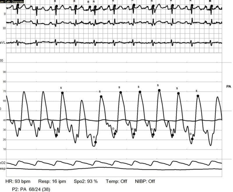 A diagnostic hemodynamic tracing from a right heart catheterization (RHC) procedure. The image displays synchronized multi-parameter monitoring data, including a three-lead electrocardiogram (ECG) at the top showing leads II, III, and aVL with a heart rate of 93 bpm. The central section features a pressure-volume waveform representing pulmonary artery (PA) pressures. Systolic peaks (S) are visualized reaching approximately 68-70 mmHg, and diastolic troughs (D) are noted at approximately 24 mmHg, indicating significant pulmonary hypertension. A concurrent flatter waveform represents the pulmonary capillary wedge pressure (PCWP), with a mean value indicated around 38 mmHg. Bottom panels display digital telemetry data including a plethysmographic oxygen saturation (SpO2) of 93% and a respiratory rate of 16 inspirations per minute (ipm). This tracing is used in clinical cardiology and pulmonology to evaluate pulmonary vascular resistance and hemodynamic response in patients with systemic sclerosis-associated pulmonary arterial hypertension.