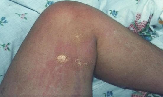 This clinical photograph displays a dermatological condition on the lower limb of a patient, specifically involving the inner thigh and the medial aspect of the knee. The primary finding is a diffuse, salmon-colored to pinkish-red maculopapular eruption. The rash exhibits a mottled and somewhat confluent appearance, with erythema extending across the cutaneous surface. Notably, there are focal areas with a shiny, glistening texture and superficial excoriations, characteristic of pruritic lesions damaged by scratching (lichenification or secondary skin damage). The morphology and 'salmon-colored' hue of the eruption are clinically significant, often associated with systemic inflammatory conditions or specific viral exanthems in dermatology. No distinct vesicles or large pustules are present, though the skin surface appears uneven. This image serves as an educational resource for identifying inflammatory skin patterns and signs of secondary irritation due to pruritus.