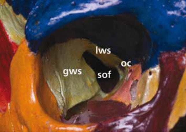 A clinical photograph of an anatomical skull model focused on the right orbital apex, highlighting the complex bony architecture. The sphenoid bone is central to the anatomy, with labels identifying the optic canal (OC), superior orbital fissure (SOF), greater wing of the sphenoid (GWS), and lesser wing of the sphenoid (LWS). The optic canal (OC) is situated medially, bordered superiorly by the LWS and medially by the sphenoid body. The superior orbital fissure (SOF) is a larger, more lateral cleft-like opening located inferolateral to the optic canal, separated from it by the optic strut. The boundaries of the SOF include the LWS superiorly and medially, and the GWS forming the lateral margin. The different bones are color-coded to differentiate cranial structures, with the orbital roof in blue and the lateral orbital wall in orange/yellow. This image serves as an educational tool for medical students and clinicians to understand the spatial orientation of neurovascular conduits at the orbital apex, which are critical in ophthalmology, neurosurgery, and maxillofacial surgery.