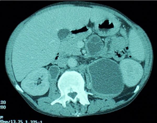 Axial cross-section of an abdominal computerized tomography (CT) scan at the level of the kidneys. The image demonstrates multiple, significantly enlarged, low-attenuation masses in the mesenteric and retroperitoneal regions. These structures exhibit rounded and oval morphologies with internal densities suggesting fluid or liquefactive necrosis, consistent with necrotic or abscessed lymphadenopathy. A prominent large, hypoattenuating fluid collection is visible in the left retroperitoneal space adjacent to the vertebral body and kidney. The surrounding soft tissues show mottled attenuation and architectural disruption, indicative of an active inflammatory process. Clinically, such findings in the context of advanced HIV/AIDS and Immune Reconstitution Inflammatory Syndrome (IRIS) are characteristic of disseminated Mycobacterium avium complex (MAC) infection leading to suppurative lymphadenitis. The image provides an educational example of severe intra-abdominal infection and the radiographic appearance of necrotic lymph nodes in immunocompromised patients.