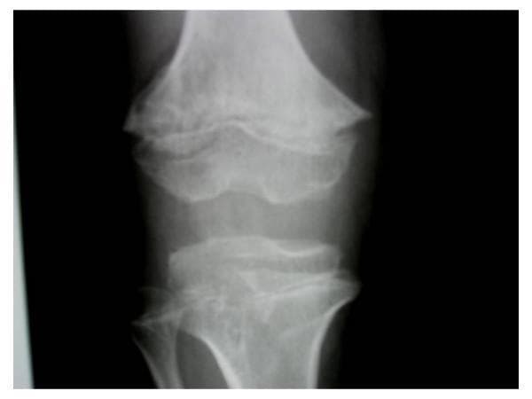 This anteroposterior radiograph of the knee demonstrates skeletal dysplasia characterized by significant metaphyseal irregularities in both the distal femur and proximal tibia. Key diagnostic features include prominent metaphyseal cupping and an abnormal trabecular pattern containing multiple small, enchondroma-like lucent lesions. The internal architecture of the metaphyses shows characteristic rings, arcs, and dense punctate foci, consistent with cartilaginous matrix calcification. These findings are typical of enchondroma-like metaphyseal dysplasia, often associated with systemic skeletal conditions like achondroplasia or Ollier disease. The visual focus is on the junction between the diaphysis and epiphysis, highlighting the expansion and morphological distortion of the growth zones.
