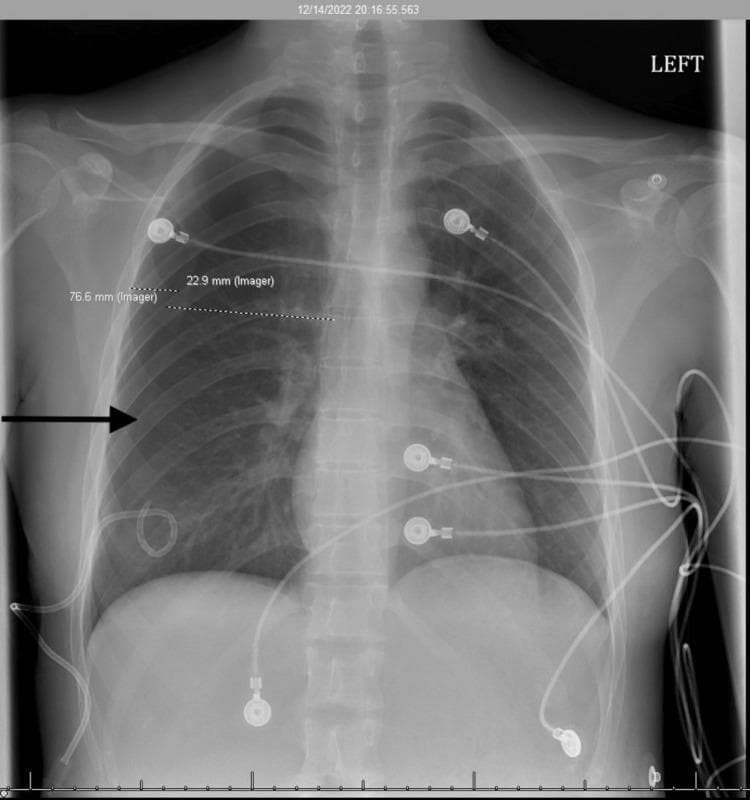 This anterior-posterior (AP) chest X-ray demonstrates a right-sided pneumothorax in a young adult patient. Key findings include a visible visceral pleural line and an absence of pulmonary markings in the right upper and mid-periphery of the thoracic cavity, indicating air accumulation in the pleural space. Measurements on the image note an interval decrease in the pneumothorax size. A pigtail catheter is in situ, with its distal curled tip positioned in the right lower hemithorax for drainage. Multiple external monitoring devices are present, including ECG leads and cables overlying the chest wall. The contralateral left lung appears clear without evidence of consolidation, effusion, or edema. The mediastinal structures and heart size are within normal limits. This diagnostic image illustrates the management of catamenial pneumothorax, characterized by the temporal relationship between menstruation and pleural air leakage.