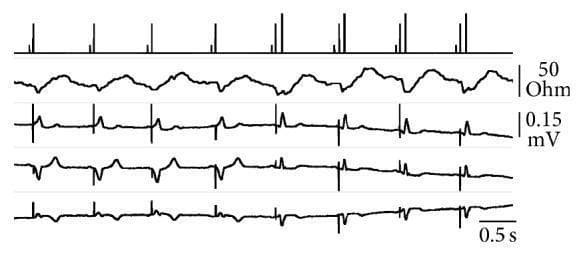This diagnostic image displays real-time cardiac telemetry and surface ECG tracings (leads I, II, and aVR) during a ventricular pacing threshold analysis in VDD mode. The top tracing shows event markers: short vertical bars indicate atrial sensing, intermediate bars represent ventricular pacing pulses, and the longest bars signify ventricular sensing within the refractory period. The second tracing illustrates transvalvular impedance (TVI), used as a hemodynamic sensor to confirm ventricular ejection. Initially, the ECG shows wide QRS complexes evoked by ventricular pacing. From the fifth pulse onward, the stimulation intensity falls below the myocardial threshold, resulting in a transition to narrow QRS complexes indicative of intrinsic conduction. Despite the loss of electrical capture, the TVI tracing maintains rhythmic fluctuations, demonstrating that mechanical ventricular ejection continues via natural activation. This comparison highlights the clinical utility of TVI in distinguishing between electrical capture loss and the total absence of mechanical contraction, facilitating safer pacemaker autoregulation and capture surveillance.