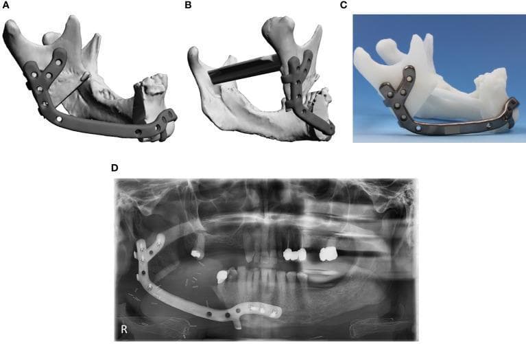 A multi-panel figure illustrating the planning, physical model, and postoperative outcome of a complex patient-specific implant (PSI) for mandibular reconstruction. Panels A and B display 3D digital planning lateral and posterior-lateral views, showing a virtual model of a metallic implant conforming to the mandibular ramus and body. The implant features a characteristic Y-shaped fixation plate at the ramus and multiple circular screw holes for stabilization. Panel C shows the physical metallic implant prototype mounted on a 3D-printed white plastic mandible model, demonstrating the precise anatomical fit. Panel D is a postoperative orthopantomogram (panoramic X-ray) showing the radiopaque implant in situ, extending from the mandibular symphysis to the ramus. The radiographic image confirms the position of the fixation screws and the restoration of mandibular continuity following a segmental resection. This visual material is intended for oral and maxillofacial surgery education, focusing on Computer-Aided Design/Computer-Aided Manufacturing (CAD/CAM) in reconstructive surgery.
