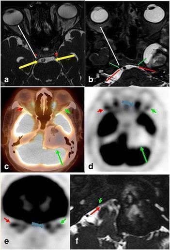 This composite of diagnostic images illustrates the neuroanatomy of the oculomotor (CN III) and abducens (CN VI) nerves and their clinical involvement in pathology. Panels (a) and (b) utilize axial FIESTA MRI to demonstrate normal anatomy: yellow arrows track CN III from its cisternal segment into the cavernous sinus (asterisk), while red arrows show CN VI entering Dorello’s canal (green arrow). The white arrows indicate their anterior trajectory toward the superior orbital fissure. Panels (c) through (e) present axial and coronal fused FDG PET/CT and PET-only images of a 73-year-old male with diplopia. A large, peripherally ossified, hypometabolic mass is visible in the left petrous apex and cerebellopontine angle (long green arrow). Functional denervation is demonstrated by reduced FDG uptake in the left lateral rectus muscle (short green arrow) compared to the normal right side (red arrow), with compensatory hypermetabolism in the left medial rectus muscle. High-resolution MRI (f) confirms the mass involves the expected anatomical course of the left abducens nerve, contrasting with the visible normal right nerve.