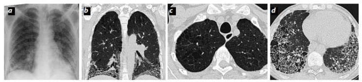 This composite figure illustrates the radiological findings of Combined Pulmonary Fibrosis and Emphysema (CPFE). (a) Posterior-anterior chest radiograph demonstrates bilateral basal reticular opacities and an enlarged interlobar artery, suggestive of pulmonary hypertension. (b-d) High-resolution computed tomography (HRCT) in coronal (b) and axial (c, d) planes reveals a distinct cranio-caudal distribution of pathology. The upper lobes (c) show centrilobular emphysema characterized by multiple areas of low attenuation without perceptible walls. The lower lobes (d) exhibit features of advanced interstitial fibrosis, including subpleural honeycombing, traction bronchiectasis, and significant volume loss. This combination of upper-lobe emphysema and lower-lobe fibrosis is the hallmark of CPFE, frequently seen in smokers and often associated with severe impairment of gas exchange (reduced DLCO) despite relatively preserved lung volumes (FVC and FEV1).