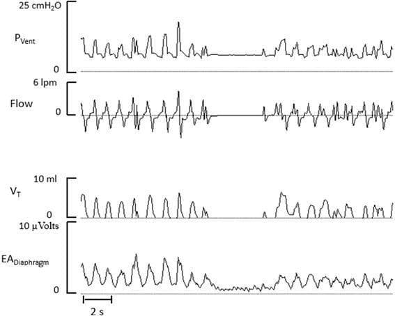 A multi-panel respiratory waveform tracing illustrating Neurally Adjusted Ventilatory Assist (NAVA) in a premature infant. The image displays four vertically stacked waveforms over time: ventilator pressure (PVent, 0–25 cmH2O), flow (0–6 lpm), tidal volume (VT, 0–10 ml), and diaphragmatic electrical activity (EADiaphragm, 0–10 μVolts). The tracings demonstrate a proportional relationship where the ventilator pressure dynamically adjusts to match the magnitude and timing of the EADiaphragm signals, reflecting the patient's spontaneous neural respiratory drive. During inspiration, a rise in EADiaphragm triggers a corresponding increase in PVent, flow, and VT. Conversely, a breathing pause is clearly visible in the middle of the tracing, where the absence of diaphragmatic electrical activity results in a cessation of ventilator pressure delivery. This clinical diagnostic image serves as an educational example of advanced neonatal synchronization and patient-triggered ventilation modes, highlighting how physiological feedback can be used to coordinate mechanical support with intrinsic respiratory effort.