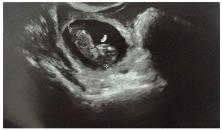 This diagnostic ultrasound image displays a live tubal ectopic pregnancy at a gestational age of approximately 10 weeks and 4 days. The image shows a well-defined, hypoechoic (anechoic) gestational sac located outside the uterine cavity within the adnexal region. Inside the fluid-filled sac, a distinct embryo (fetal pole) is visible with a measurable Crown Rump Length (CRL). An echogenic yolk sac is seen adjacent to the embryo. The surrounding tubal and pelvic tissue exhibits a heterogeneous echotexture characteristic of an ectopic implantation site. Measurement calipers (+) are positioned across the gestational sac to assess dimensions. The image demonstrates key sonographic findings of an advanced extrauterine pregnancy, emphasizing the presence of a gestational sac and fetal pole in the fallopian tube, which is a critical diagnostic indicator in obstetric emergency medicine and radiology.