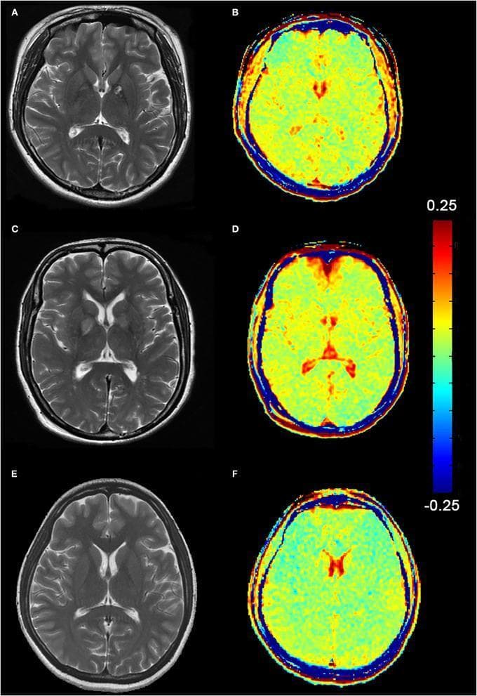 A comparative diagnostic imaging panel showing axial brain MRI slices from two patients with acute carbon monoxide (CO) poisoning (A-D) and one healthy control (E-F). The panel contrasts structural T2-weighted imaging (T2WI) with functional Glutamate Chemical Exchange Saturation Transfer (GluCEST) mapping. Subfigures A and C (T2WI) reveal bilateral hyperintensities in the globus pallidus, a characteristic sign of CO-induced hypoxic-ischemic injury. Subfigures B and D display the corresponding GluCEST maps, where a color-coded scale (ranging from -0.25 to 0.25) indicates higher glutamate levels in shades of yellow and red. These maps demonstrate markedly elevated GluCEST signals in the basal ganglia and cerebral white matter of the patients compared to the control. In contrast, subfigures E (T2WI) and F (GluCEST) show normal neuroanatomy and a uniform, low-intensity glutamate distribution. This educational comparison highlights the utility of metabolic CEST imaging in detecting neurochemical alterations that correlate with structural damage in toxic encephalopathy.