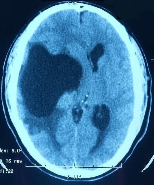 Axial non-contrast computed tomography (CT) scan of the brain demonstrating a large, well-circumscribed, hypodense lesion in the right temporal and frontoparietal regions. The lesion exhibits significant mass effect, evidenced by a marked midline shift toward the left and subfalcine herniation. The right lateral ventricle is severely compressed and effaced, while the contralateral left lateral ventricle shows compensatory enlargement or distortion. Peripheral vasogenic edema is visible as ill-defined hypodensity in the adjacent white matter. These findings are consistent with a space-occupying intracranial lesion, such as a large cyst, tumor, or abscess. Clinical context suggests this specific case involves neurosarcoidosis presenting as a granulomatous mass, initially mimicking cerebral tuberculosis. This image is educational for illustrating intracranial mass effect, ventricular compression, and midline shift in neuro-radiology.