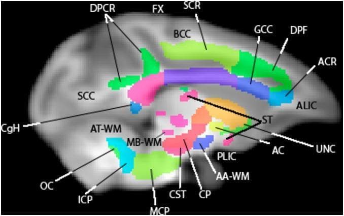 This diagnostic image shows a sagittal slice of a human brain white matter atlas overlaid on a T1-weighted MRI template. The visualization utilizes color-coded regions of interest (ROIs) to define specific neuroanatomical tracts. Superiorly, the corpus callosum is segmented into the green genu (GCC), light-green body (BCC), and pink splenium (SCC). The internal capsule is delineated by the light-blue anterior limb (ALIC) and the dark-blue posterior limb (PLIC). Other prominent structures include the green corticospinal tract (CST) descending through the brainstem, the cerebral peduncle (CP) in pink, and the middle cerebellar peduncle (MCP) in light green. Deep structures such as the fornix (FX), stria terminalis (ST), and anterior commissure (AC) are also identified. This anatomical diagram serves as a reference for fiber tract orientation and localization, demonstrating the relationship between major commissural, projection, and association fibers in the rhesus macaque or human-approximate brain for educational and research-based neuroimaging analysis.