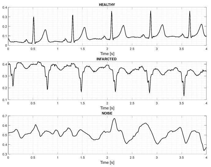 This diagnostic image displays a comparison chart of three separate electrocardiogram (ECG) waveforms over a 4-second time window, categorized as 'Healthy', 'Infarcted', and 'Noise'. The 'Healthy' trace exhibits a physiological sinus rhythm characterized by repeating, well-defined P-waves, narrow QRS complexes (peaking at ~0.35 mV), and distinct T-waves. The 'Infarcted' trace shows significant morphological alterations, including a shift in baseline and deep, irregular downward deflections suggestive of pathological Q-waves or significant ST-segment deviations associated with myocardial infarction. The 'Noise' trace illustrates a chaotic signal with high-frequency artifacts and wandering baseline (amplitude 0.35-0.65 mV), where no discernible cardiac components (P-QRS-T) are present. This visual comparison is utilized in medical signal processing and neural network training for automated cardiac event detection and signal quality assessment, highlighting the distinctive temporal and morphological features used to differentiate normal cardiac activity from ischemic events and signal interference.