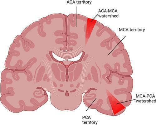 Anatomical diagram of a coronal brain section illustrating cerebral vascular territories and watershed (border zone) regions. The diagram identifies three primary arterial territories: the Anterior Cerebral Artery (ACA) territory in the medial cortex, the Middle Cerebral Artery (MCA) territory in the lateral cortex, and the Posterior Cerebral Artery (PCA) territory in the inferior-medial cortex. Two critical watershed zones are highlighted in red: the ACA-MCA watershed, appearing as a superior wedge-shaped area at the border of the medial and lateral hemispheres, and the MCA-PCA watershed, located at the inferior-lateral border. The illustration demonstrates the clinical concept of hypoperfusion injury, where these distal arterial junctions are most susceptible to ischemia during acute hypotension. Labels and anatomical landmarks including the cerebral cortex, ventricles, and subcortical structures provide orientation for neuroanatomical and radiological correlation in the study of watershed infarcts.