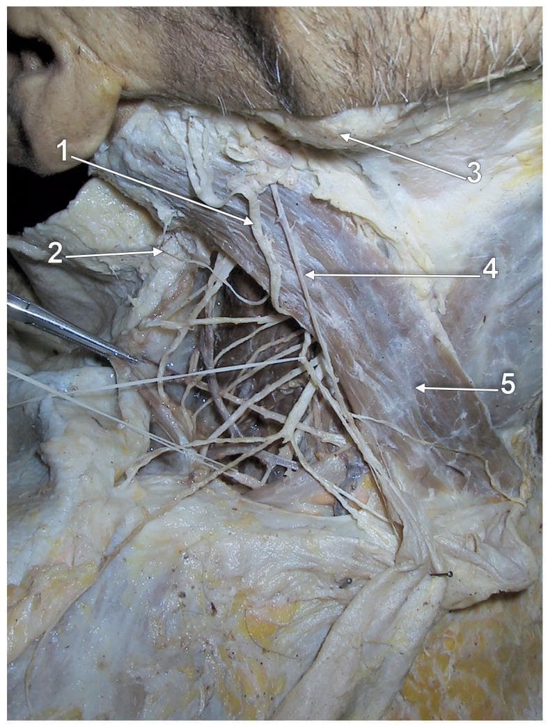 This clinical photograph displays a right-sided lateral view cadaver dissection focusing on the anatomical variations of the neck's vascular and nervous systems. The primary focus is a hypoplastic external jugular vein (labeled 4), which is characterized by a significantly reduced caliber as it courses superficially over the anterior surface of the sternocleidomastoid muscle (5). The dissection clearly illustrates the spatial relationships between this venous variant and adjacent cutaneous nerves: the greater auricular nerve (1) is seen in close proximity to the upper segment of the vein, and the lesser occipital nerve (2) is located superiorly. The angle of the mandible (3) serves as a superior anatomical landmark. This image demonstrates a common morphological variation where normal external jugular vein formation occurs with hypoplastic development, potentially requiring compensatory drainage through anastomotic vessels. This material is suitable for advanced medical education in gross anatomy, surgical planning, and radiology to recognize vascular anomalies.