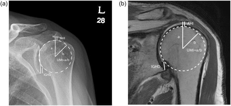 This figure presents a comparative analysis of shoulder joint measurement techniques using two different imaging modalities: (a) an anterior-posterior (AP) radiograph and (b) a coronal T1-weighted magnetic resonance image (MRI). Both images illustrate the quantitative assessment of superior humeral head migration, a key clinical indicator of rotator cuff pathology. The diagrams demonstrate three primary radiographic indices: the Acromiohumeral Interval (AHI), measured as the vertical distance between the inferior surface of the acromion and the superior margin of the humeral head; the Inferior Glenohumeral Distance (IGHD), defined between the inferior glenoid tubercle and the inferior humeral head margin; and the Upward Migration Index (UMI). The UMI is visually calculated by dividing the distance 'a' (lowest acromion point to the center of the humeral head) by 'b' (the radius of the humeral head). The radiograph (a) emphasizes high-density cortical bone structures, while the MRI (b) provides superior soft tissue resolution, allowing for better visualization of the deltoid muscle, subacromial space, and glenohumeral articular surfaces. This comparison highlights the multi-modal approach used in orthopedic radiology to evaluate shoulder stability and cuff integrity.