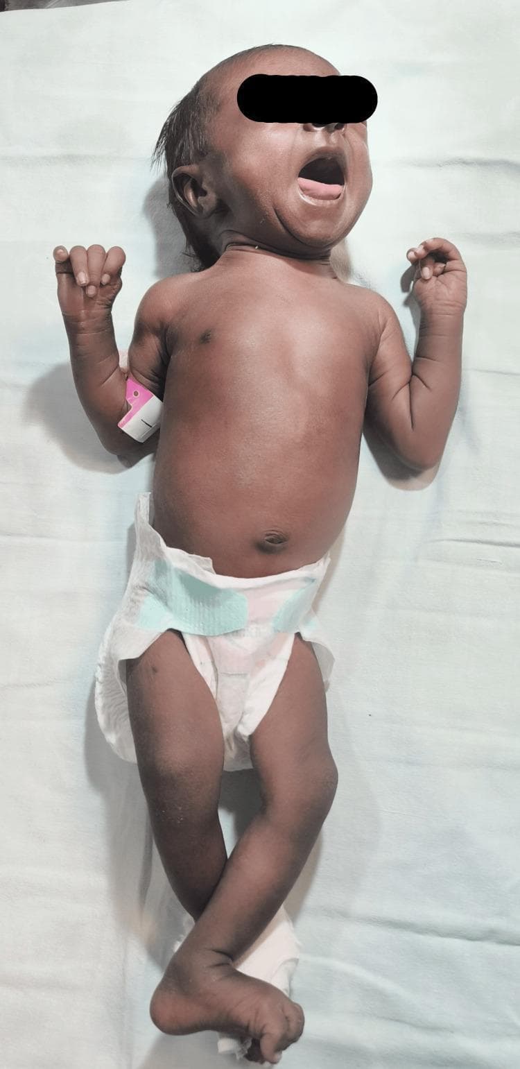 This clinical photograph displays a female neonate in a supine position, illustrating generalized hyperpigmentation of the skin. The pigmentation is diffuse and relatively uniform across the face, torso, and extremities, presenting as a deep bronze or dark brown hue. The skin texture appears smooth without visible primary lesions, rashes, or mottling. Key clinical features include the absence of visible jaundice or cyanosis, although the intense pigmentation can mask subtle vascular changes. An identification band is visible on the upper left arm, and a diaper is in place. In a neonatal context, such progressive, generalized hyperpigmentation is a significant clinical sign often associated with endocrine disorders, specifically primary adrenal insufficiency (such as Congenital Adrenal Hyperplasia), where elevated levels of adrenocorticotropic hormone (ACTH) lead to increased melanocyte stimulation. This image serves as an educational tool for recognizing systemic manifestations of metabolic and endocrine pathologies in pediatrics.