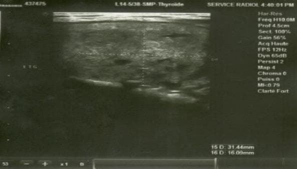 Diagnostic Image: This ultrasound scan of the cervical region captures a thyroid gland exhibiting characteristics of a multinodular goiter. The thyroid parenchyma is markedly heterogeneous, containing multiple nodules of varying echogenicity. A prominent hypoechoic nodule in the left lobe is shown, measuring approximately 13x16 mm. This specific nodule presents with blurred, ill-defined margins and internal punctate hyperechoic foci suggestive of microcalcifications. The overall sonographic appearance is classified as TI-RADS 4B, indicating a high suspicion for malignancy and requiring further evaluation such as fine-needle aspiration. The clinical context involves a patient with suspected Multiple Endocrine Neoplasia (MEN) type 2, given the coexistence of thyroid nodules and a pheochromocytoma. This imaging is critical for endocrinology and radiology students to recognize suspicious sonographic features (hypoechogenicity, irregular borders, microcalcifications) in thyroid pathology.